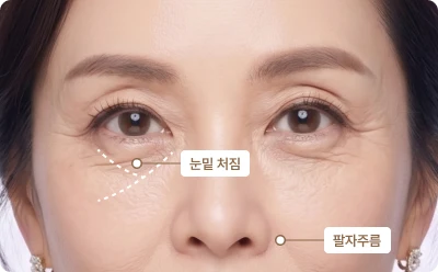 V자 또는 Y골 형성