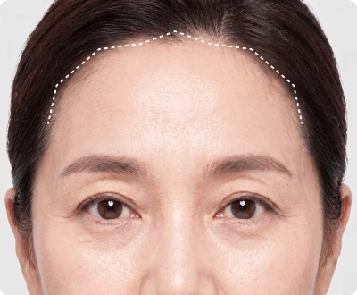 모근 방향을 고려한 절개