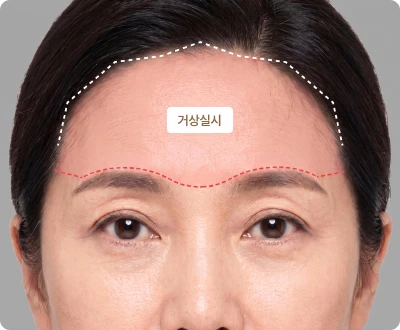 두피 상태에 맞춘 박리와 이동