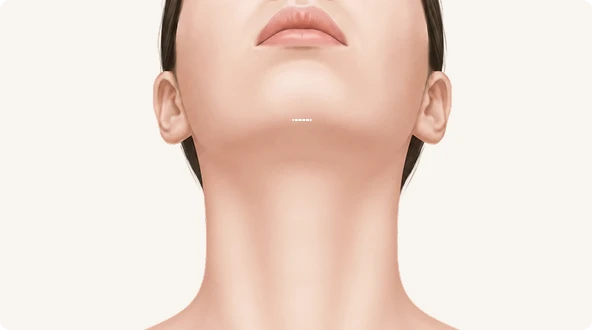 턱밑 절개 위치 설계